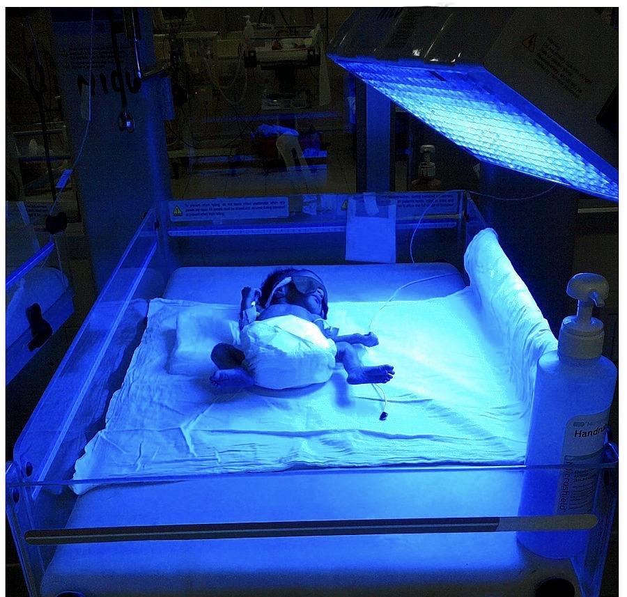 Why does neonatal jaundice continue to persist?